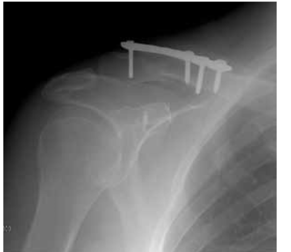 Kemal Gokku§, Murat Saylik, Ahmet Turan Aydin;Tightrope fixation of neer type II distal clavicle fracture supported by a case series. Pol Orthop Traumatol,Kemal Gokku§, Murat Saylik, Ahmet Turan Aydin