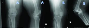 Outcome of mobile and fixed unicompartmental knee arthroplasty and risk factors for revision