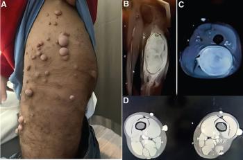 A case report of giant malignant schwannoma of the sciatic nerve associated with neurofibromatosis